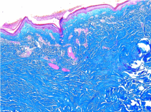 在一个58岁的女性中 Ultragenital大疱性大疱性和出血性血清巩膜sclerosus 案例报告