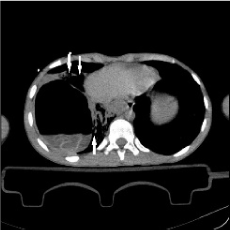 Posttaumaticpediatric肺囊肿pulatid破裂
